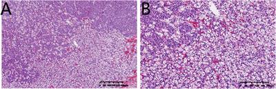 RETRACTED: Case report: A rare case of tumor-to-tumor metastasis: metastatic lobular breast carcinoma to clear cell renal cell carcinoma